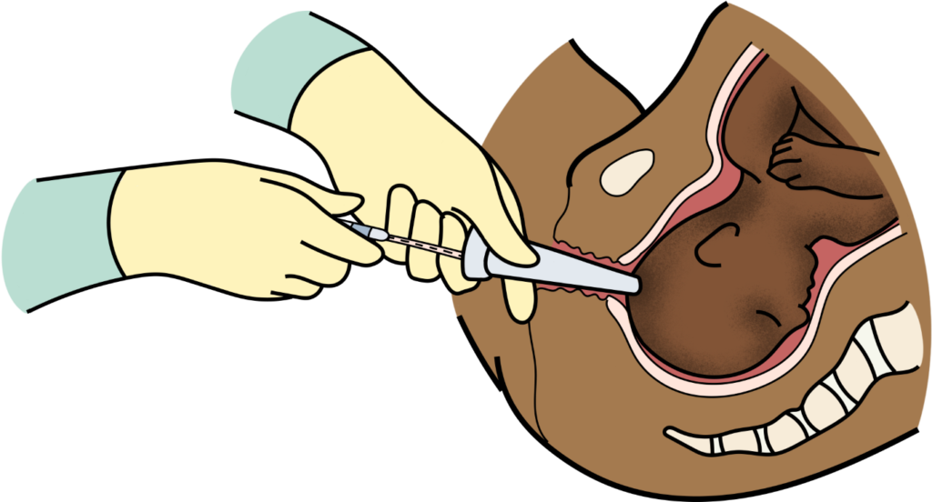 Schéma du placement de l'amnioscope