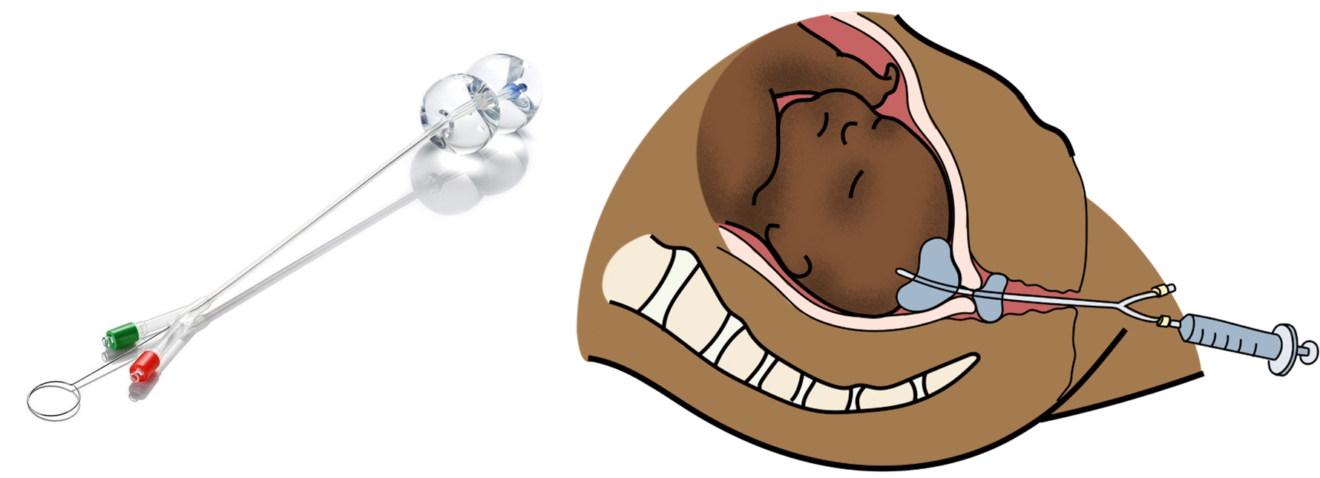 Déclenchement - Obstetricks