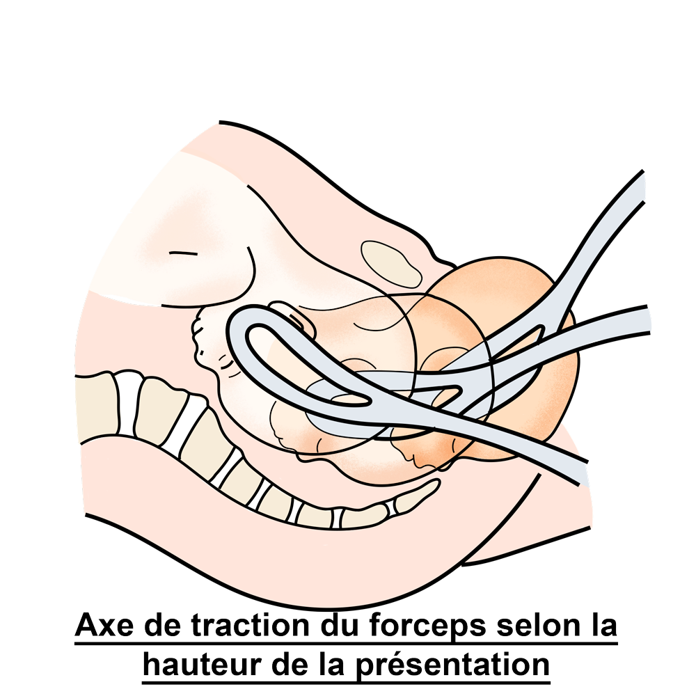 Schéma explicatif de la traction par forceps