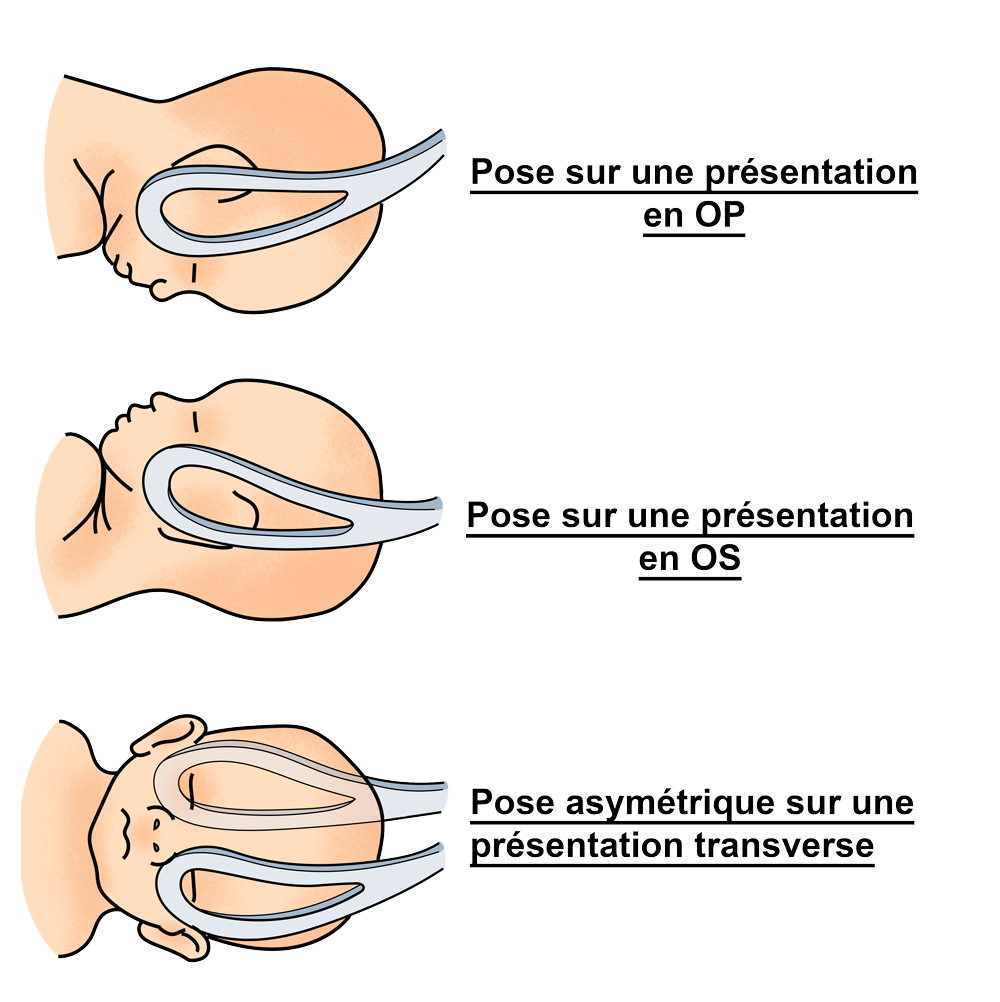 Schéma explicatif de la traction par forceps