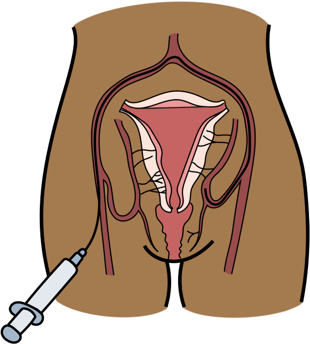 Schéma de l'embolisation artérielle