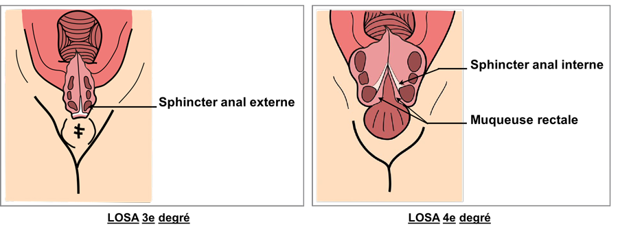 Schéma des sutures de 3eme et 4eme degrés (LOSA)