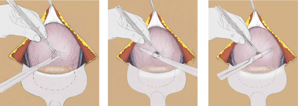 Schéma de l'incision du péritoine