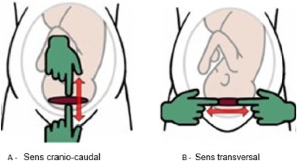 Schéma des sens de l'extension de l'incision