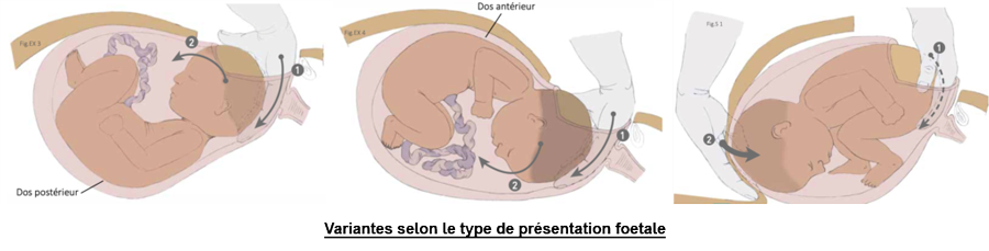 Schéma des variantes selon le type de présentation fœtale