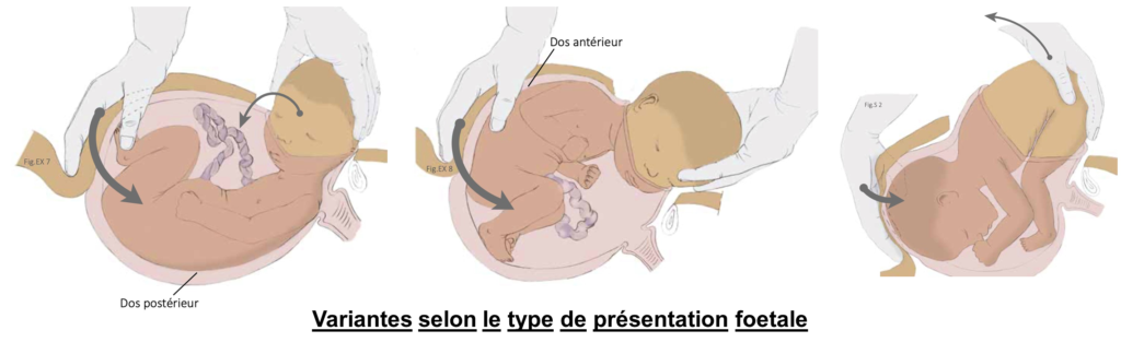 Schéma des variantes selon le type de présentation fœtale