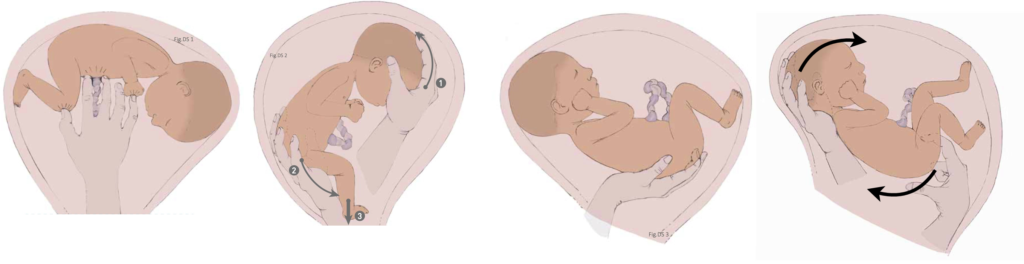 Schéma de la rotation interne du fœtus en siège