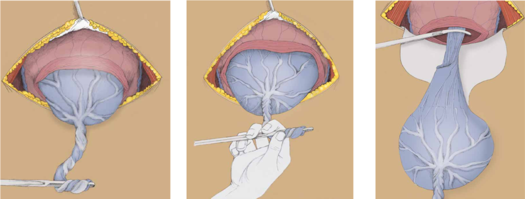 Schéma de la délivrance du placenta manuelle