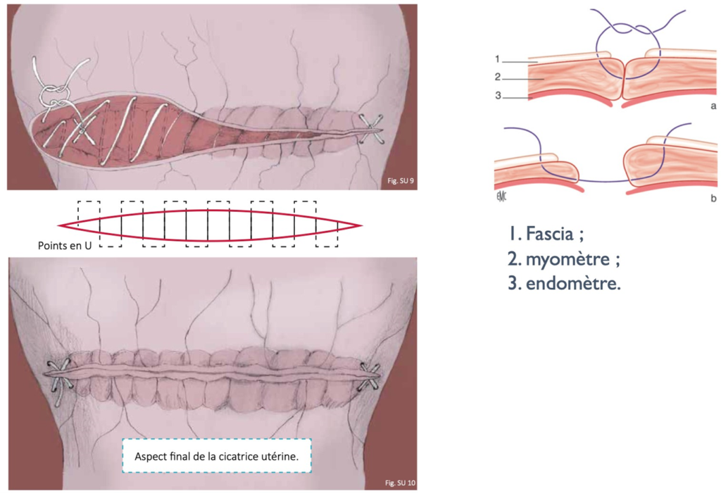 Schéma explicatif de la suture