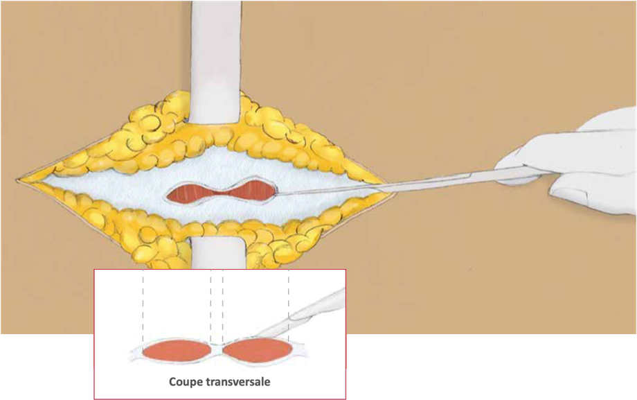 Schéma de la coupe transversale de l'incision