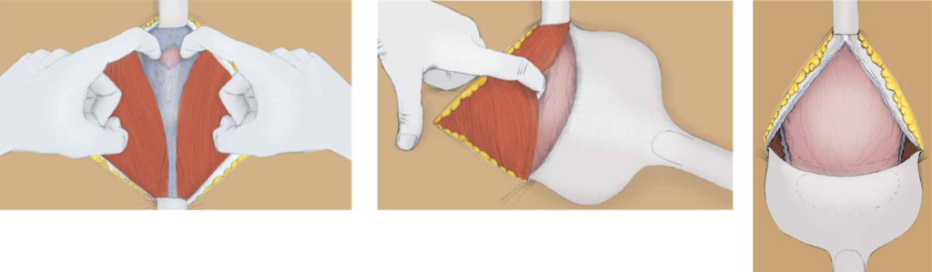 Schéma de l'ouverture du péritoine et mise en place de la valve sus pubienne