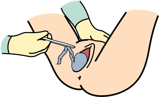 Schéma de la main qui ramène le placenta décollé