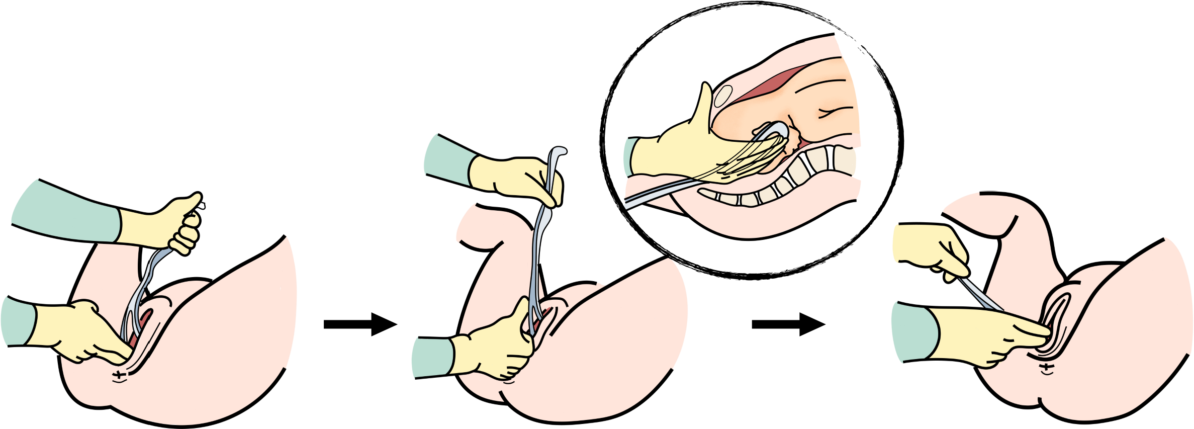 Schéma étape par étape de la manœuvre avec forceps de Tarnier