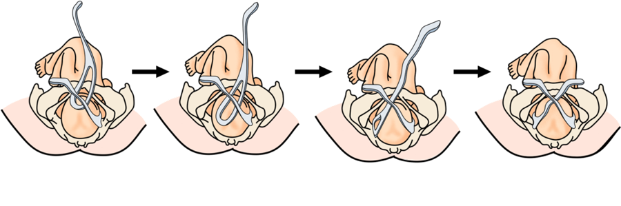 Schéma étape par étape de la manœuvre avec forceps de Tarnier