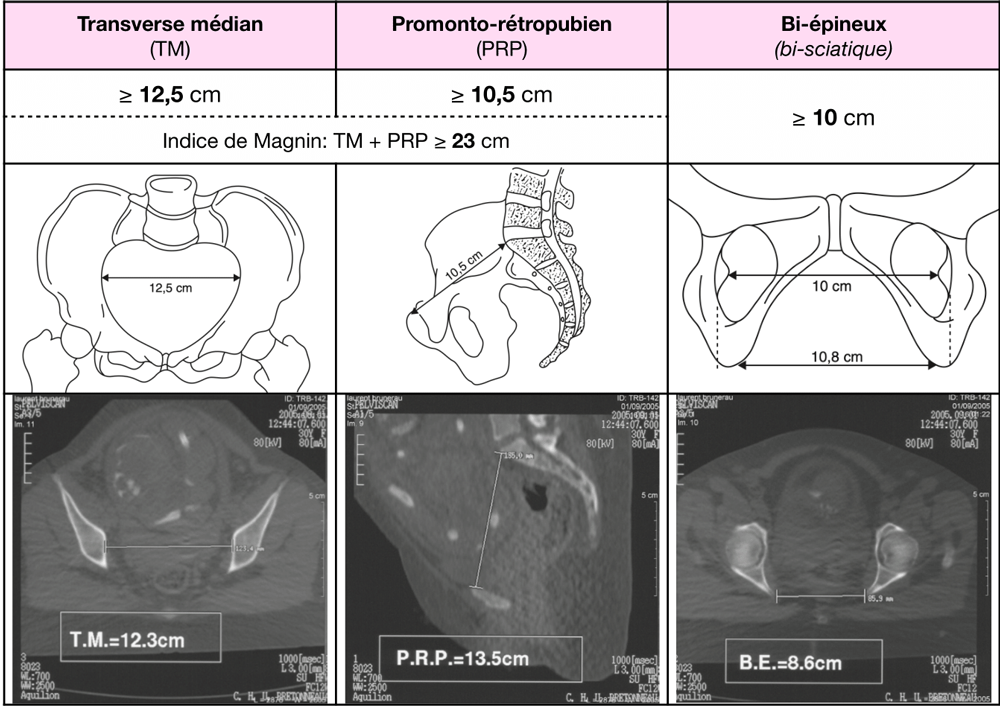 Tableau avec les normes pour bassin non pathologique : transverse médian, promonto-rétropubien et bi-épineux.