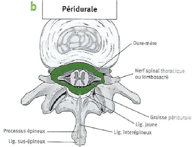 schéma de coupe pour le péridurale