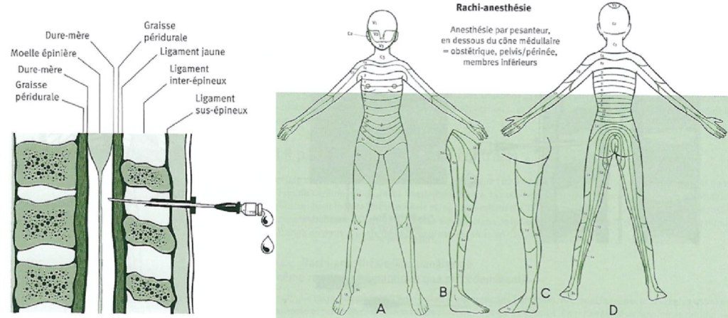 Schéma explicatif de l'endroit où faire la rachi-anesthésie