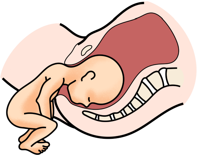 Schéma de la position du fœtus pour le dégagement de la tête