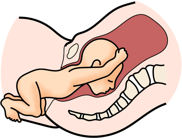 Schéma de la position du fœtus pour un dégagement des épaules