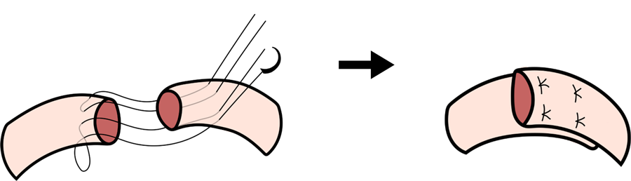 Schéma de la suture en paletot