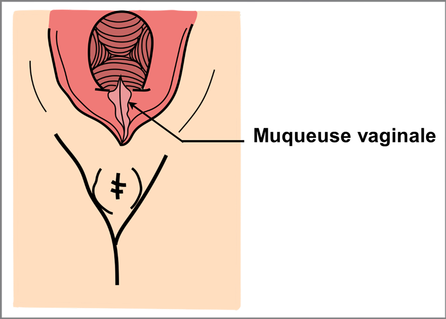 Schéma de la suture du 1er degré