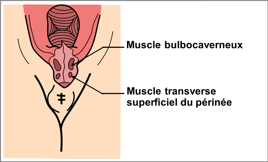 Schéma de la suture du 2ème degré