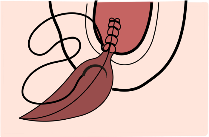 Schéma de la suture au plan vaginal