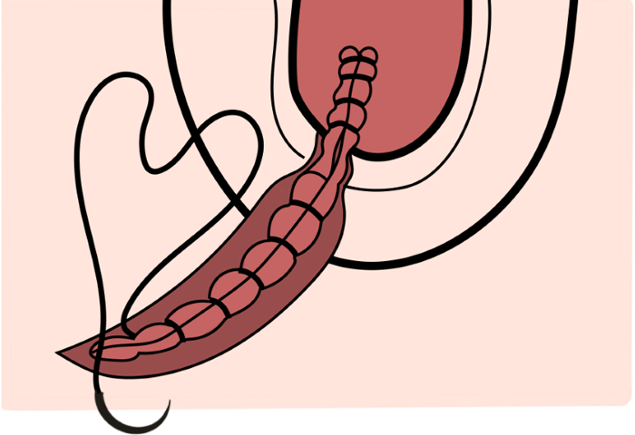 Schéma de la suture au plan musculaire