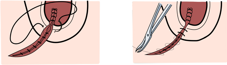 Schéma de la suture sur le plan sous-cutané et cutané