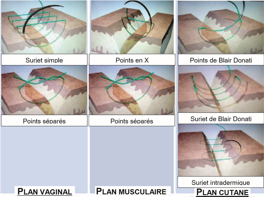 Rappel des différentes sutures selon les plans